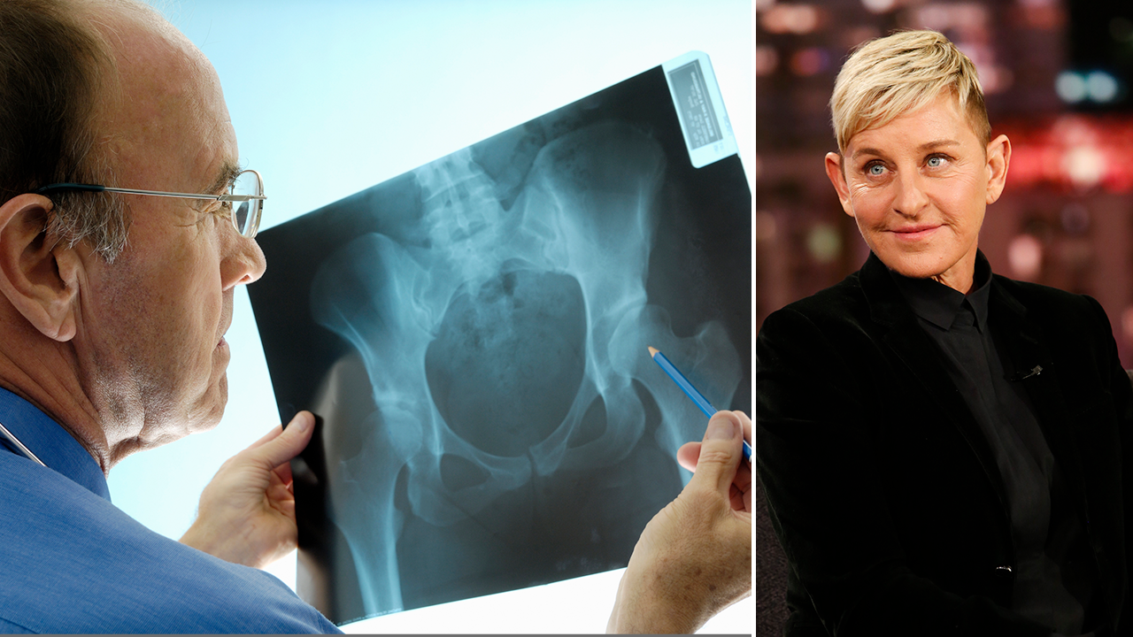 What is osteoporosis? Ellen DeGeneres was diagnosed with this bone condition